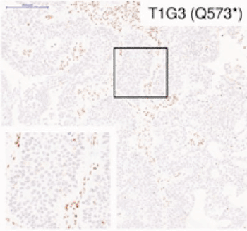 Image: This image shows a bladder tumor sample containing mutations in the STAG2 gene (Photo courtesy of the Spanish National Cancer Research Center). 
